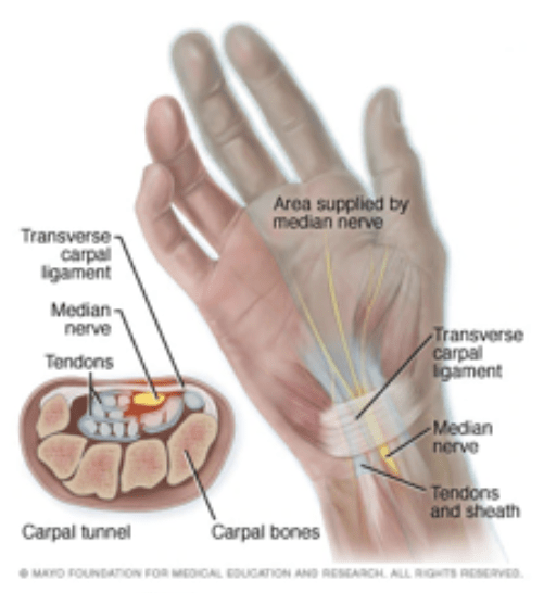 carpel tunnel syndrome hand