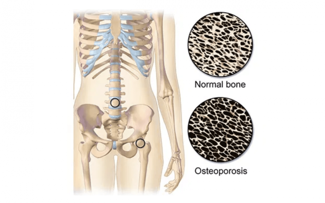 Reaching Your Full Potential While Living With Osteoporosis