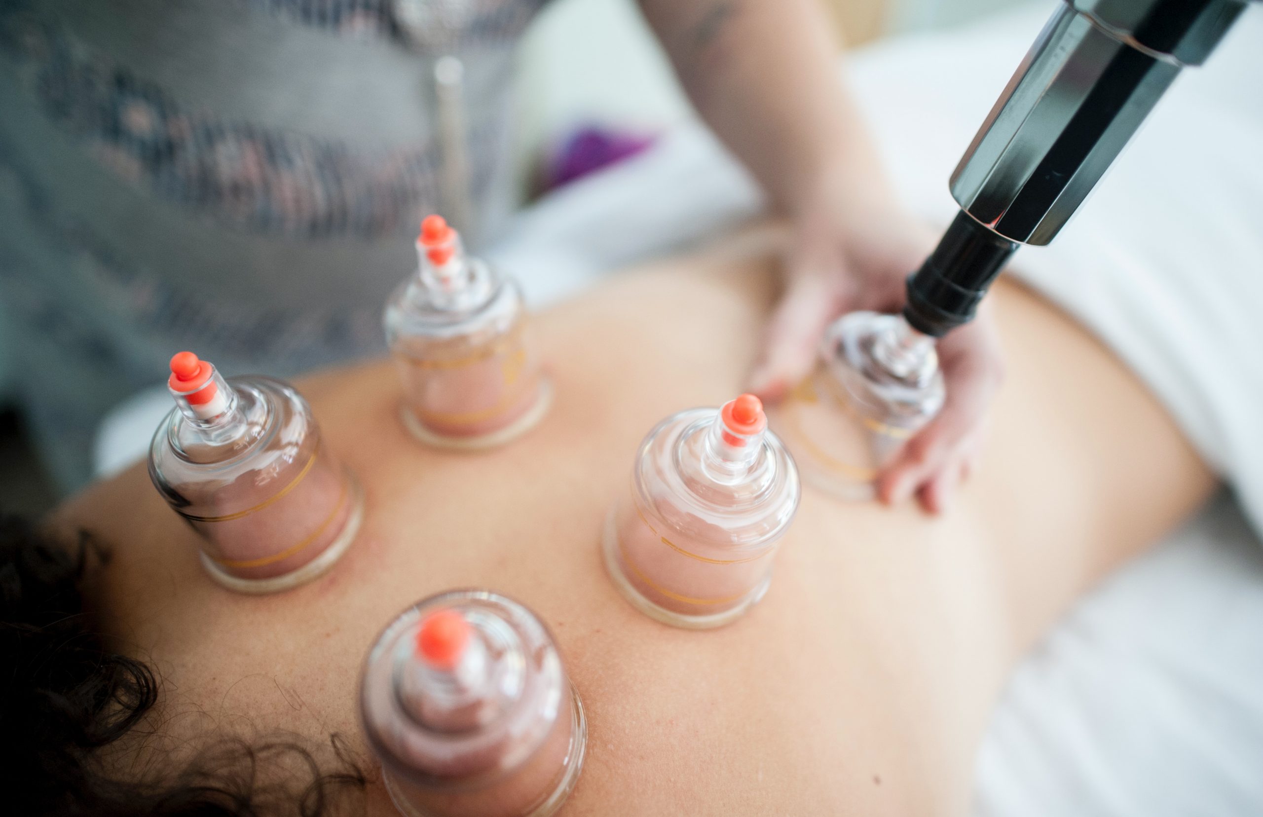 Close up image of a therapist peforming cupping therapy Queens NY on someone's back