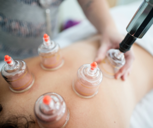 Image of a physical therapists performing cupping treatment Queens NY - ProMet PT